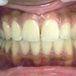 après traitement proalvéolie