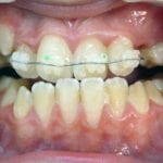 en traitement mâchoire inférieure en avant (prognathe)