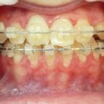 en traitement orthodontique prognathe