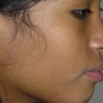 mâchoire du haut en avant (proalvéolie)