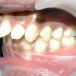 mâchoire du haut en avant proalvéolie