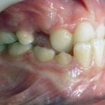 mâchoire inférieure en avant