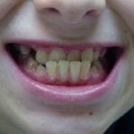 mâchoire inférieure en avant (avant traitement)