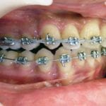 orthodontie mâchoire du haut en avant