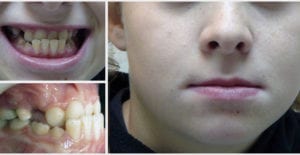 prognathe, rétrognathe, que peut faire l'orthodontie?