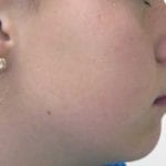 prognathe après traitement