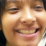 sourire après traitement mâchoire du haut en avant