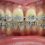 traitement orthodontique mâchoire du haut en avant