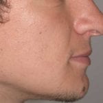 adulte après chirurgie orthodontique