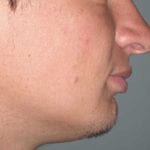 adulte avant chirurgie