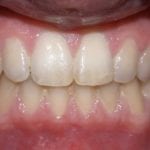 après chirurgie orthodontique, vue de face