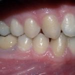 après chirurgie orthodontique, vue de profil