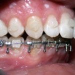 boutons pour chirurgie (profil)