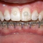 boutons transparents pour chirurgie