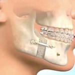 chirurgie et orthodontie sur un adulte