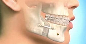 chirurgie et orthodontie sur un adulte