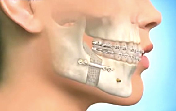 chirurgie et orthodontie sur un adulte