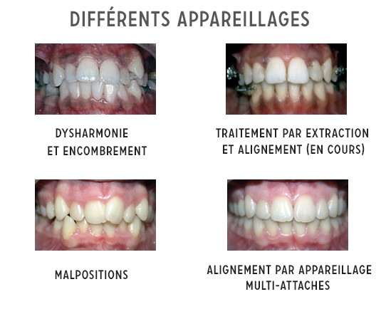 Différents appareillages orthodontiques