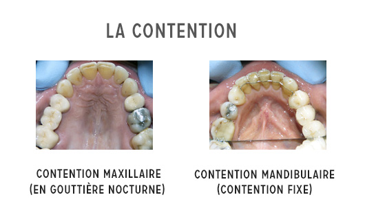 La contention. Après le traitement orthodontique actif - SFODF