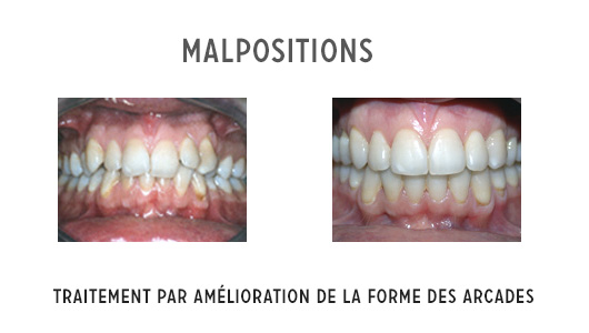 malpositions sur un adulte et traitement orthodontique