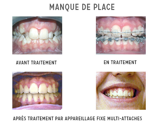 manque de place et traitement orthodontique