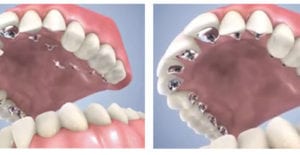 appareilllage lingual