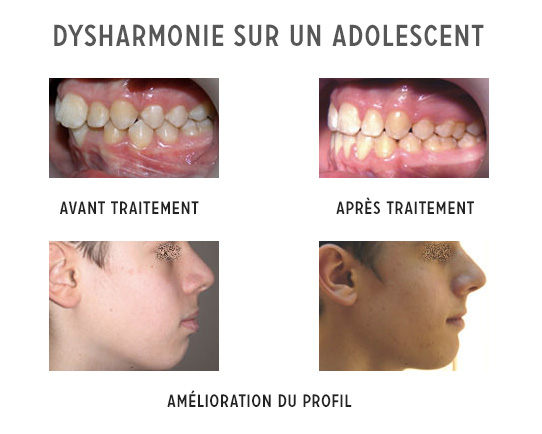 amélioration du profil d'un adolescent-orthodontie