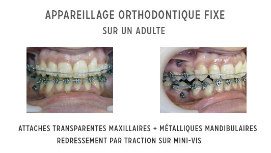 La durée du traitement d'alignement dentaire