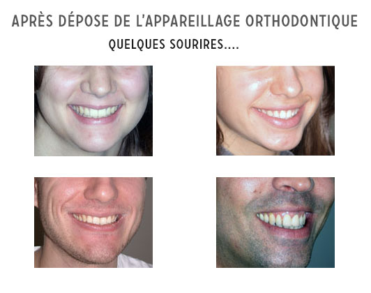 après dépose appareil orthodontique