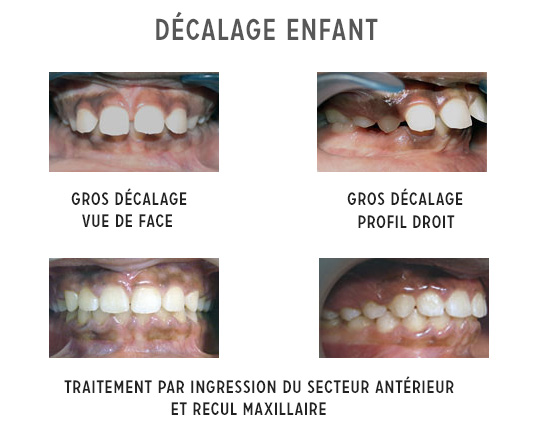 décalage mâchoires enfant