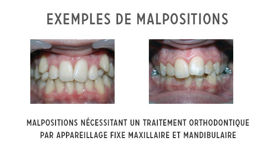 malpositions et traitement orthodontique