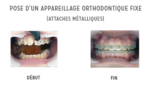 pose d'un appareil orthodontique fixe