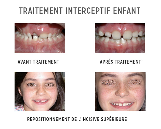 traitement interceptif enfant