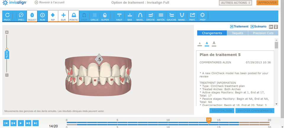 Alignements des dents avec des gouttières transparentes Rungis