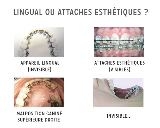 appareil orthodontique lingual