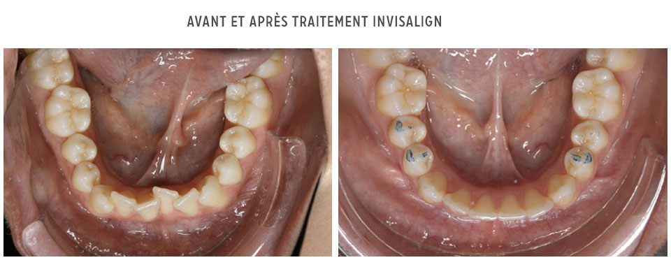 avant/après Invisalign - mandibule