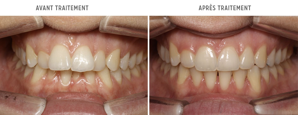 avant/après Invisalign