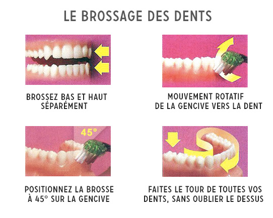 Brossage des dents et appareil orthodontique fixe