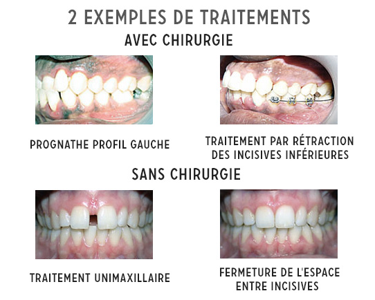 Traitement orthodontique - Dental Travels