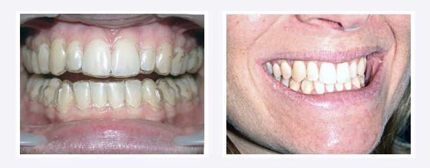 Orthodontie invisible Avesnes sur Helpe - Alignement des dents