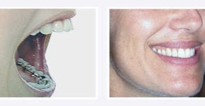 lingual chez l'adulte