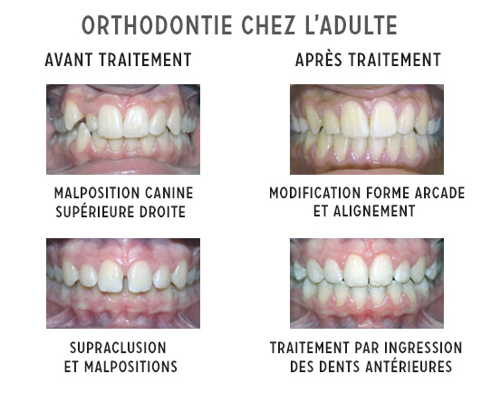 l'orthodontie chez l'adulte