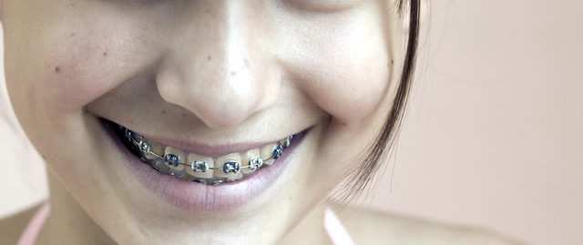 orthodontie sur une jeune fille