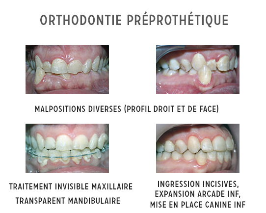 orthodontie préprothétique