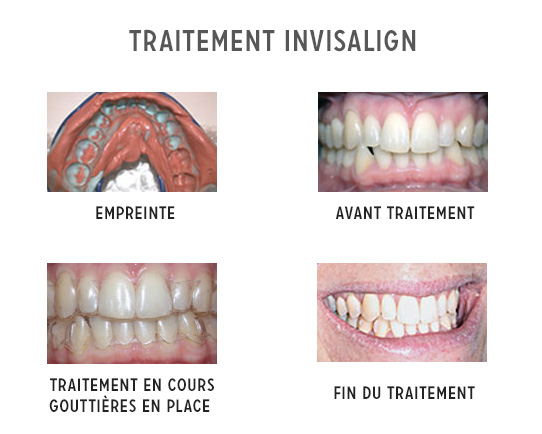 Invisalign : traitement par gouttières transparentes à Lausanne