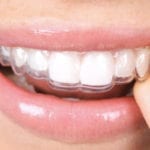 gouttière Invisalign