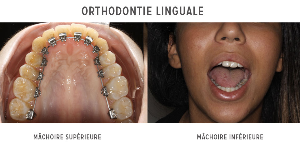 orthodontie linguale