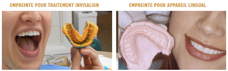 empreintes dentaires pour appareil lingual et invisalign