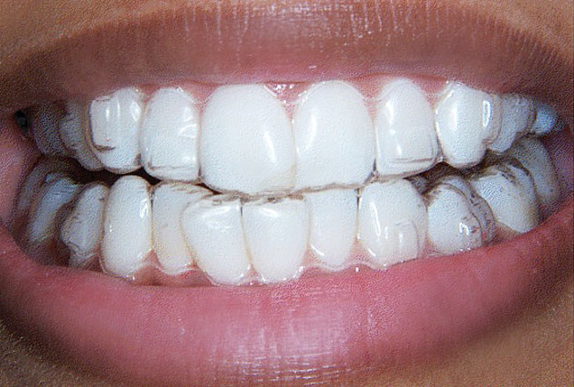 gouttière de traitement Invisalign