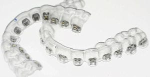 gouttières de collage pour attaches linguales